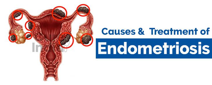 Endometriosis Surgery in India